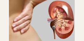 Мочекаменная болезнь или камни в почках, мочеточнике, мочевом пузыре – симптомы, диагностика, причины, лечение. Что такое литотрипсия?