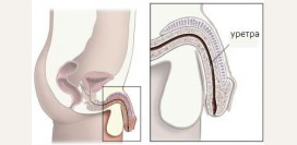 Уретрит у мужчин и женщин - причины, симптомы, признаки, диагностика и лечение. Острый, хронический, неспецифический, специфические виды уретрита . Бактериальный, кандидозный, трихомонадный уретрит