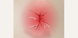 Трещина заднего прохода (анальная трещина) - причины, симптомы, диагностика и лечение патологии. Какие свечи и мази используются в лечении? 