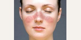 Системная красная волчанка (СКВ) – причины, патогенез, симптомы, диагностика и лечение