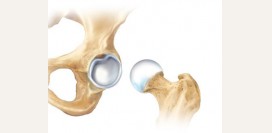 Дисплазия тазобедренного сустава – симптомы и признаки патологии. Лечение дисплазии – массаж, гимнастика, упражнения