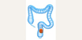 Рак прямой кишки. Симптомы и признаки, стадии, диагностика, лечение и прогноз, профилактика