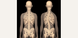 Сколиоз - симптомы и степени, диагностика и лечение. Сколиоз грудного, поясничного отделов.  Гимнастика, упражнения и массаж