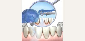 Зубной камень
