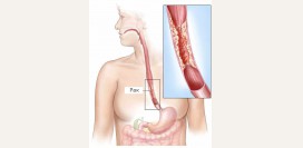 Рак пищевода. Симптомы и признаки, стадии, лечение и прогноз при заболевании.