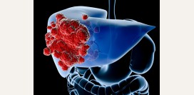 Рак печени. Симптомы, признаки, диагностика и лечение болезни.
