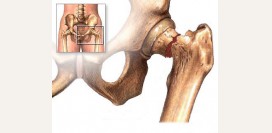  Перелом шейки бедра – причины, симптомы, диагностика и лечение. Последствия перелома, операция и реабилитация