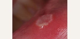 Стоматит - язвочки во рту у детей и взрослых. Симптомы, причины, признаки, лечение стоматита слизистой губ, щеки и языка