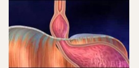 Грыжа пищевода - симптомы, причины, диагностика и лечение. Виды: диафрагмальная, скользящая, аксиальная, блуждающая. Операция по удалению грыжи пищевода