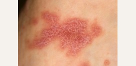 Красный лишай. Красный лишай у взрослых и детей — как выглядит, как его лечить? 