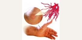 Стригущий лишай у человека. Симптомы, причины, лечение для взрослых и детей