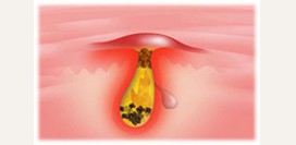 Черные точки ( комедоны ) на коже лица и тела. Как избавиться от черных точек в домашних условиях?