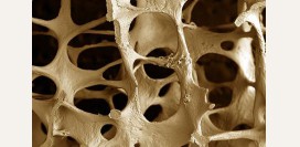 Остеопороз - причины, симптомы и признаки, диагностика и лечение