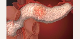Рак поджелудочной железы. Симптомы и признаки, причины, диагностика, лечение. Стадии и виды рака поджелудочной железы.  Операция, химиотерапия