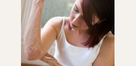 Розовый лишай. Розовый лишай у взрослых и детей – как выглядит, как его лечить?