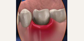 Гингивит. Причины, симптомы и признаки, диагностика и эффективное лечение заболевания. 