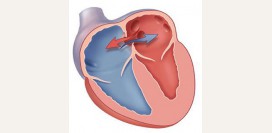 Дефект межпредсердной перегородки
