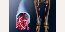 Тромбофлебит глубоких вен нижних конечностей