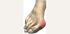 Шишки на ногах. Шишки на пальцах ног. Причины, диагностика, лечение и профилактика