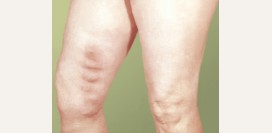 Тромбофлебит. Причины, симптомы и признаки, диагностика, лечение и профилактика.