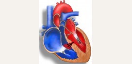 Дефект межжелудочковой перегородки