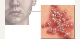 Герпес на губах - причины, симптомы и лечение герпеса
