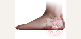 Пяточная шпора. Причины, симптомы, диагностика и эффективное лечение пяточной шпоры.