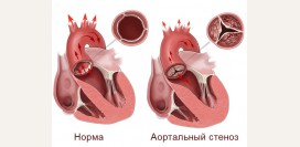 Аортальный стеноз 