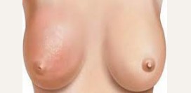 Мастит. Симптомы, причины, диагностика и лечение болезни