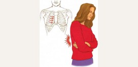 Межреберная невралгия