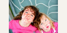 Корь. Причины, симптомы, диагностика и лечение заболевания 