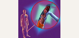 Тромбоз вен. Причины, симптомы, диагностика и лечение тромбоза