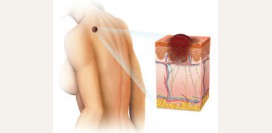 Рак кожи. Причины, симптомы и признаки, диагностика и лечение рака