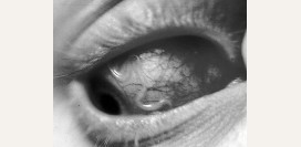 Филяриоз. Способы заражения, симптомы, диагностика и лечение