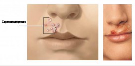 Стрептодермия. Причины, симптомы, диагностика и лечение патологии