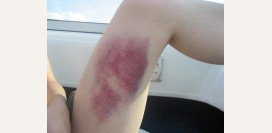 Синяк на коже. Первая помощь, как устранить за короткие сроки