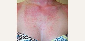 Фотодерматит. Причины, симптомы, диагностика и лечение патологии