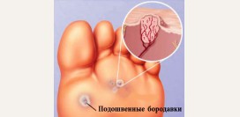 Подошвенная бородавка - причины, лечение патологии