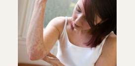 Крапивница. Причины, симптомы и признаки, первая помощь, лечение, диета при патологии