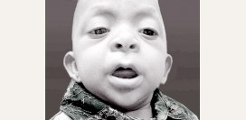 Кретинизм. Причины, симптомы и признаки, диагностика, лечение патологии