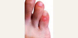 Мозоли на ногах. Причины, первая помощь, лечение и профилактика