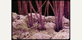 Перхоть. Причины, симптомы и лечение патологии