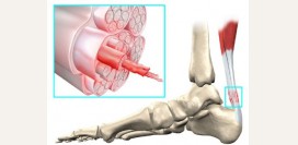 Тендинит. Механизм воспаления, симптомы, диагностика повреждения и лечение