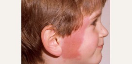 Рожистое воспаление. Причины, симптомы, лечение патологии.