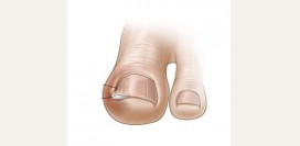 Вросший ноготь. Что делать, когда нужно удалять.