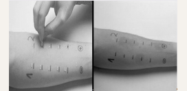 Отек Квинке (ангионевротический отек). Причины, симптомы, фото, неотложная первая помощь, лечение. 