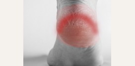 Трещины на пятках. Причины, как от них избавиться