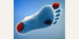 Гангрена. Причины, симптомы, диагностика и лечение патологии