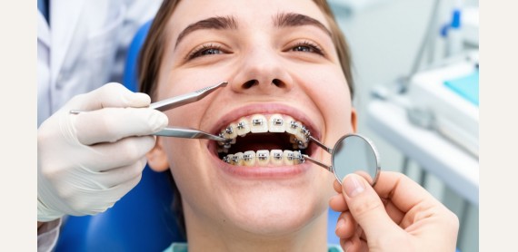 Установка брекетов: как проходит лечение и на что обратить внимание