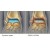 Артроз стопы (голеностопного сустава). Причины, симптомы, диагностика и лечение артроза